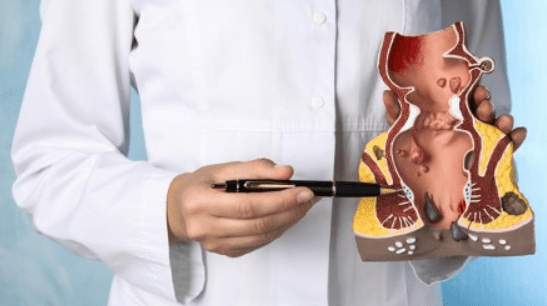 7 Foods to Avoid with&nbsp;Hemorrhoids